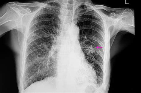 lungs infected with pneumonia